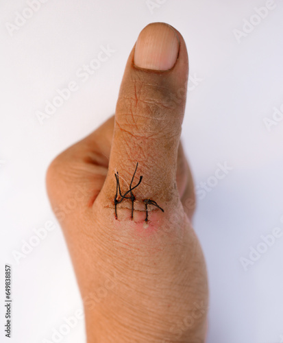 Stitches on a thumb. Stitches used to stitch up skin of a thumb on isolated white background. Selective focus.