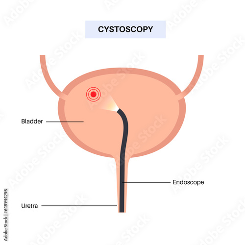 Cystoscopy examination concept