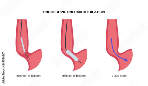 Endoscopic pneumatic dilation photo