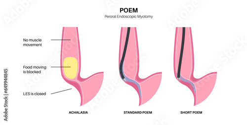 POEM medical poster