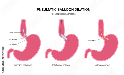 Endoscopic pneumatic dilation