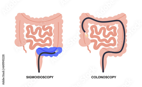 Colonoscopy and sigmoidoscopy