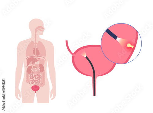 Cystoscopy examination concept