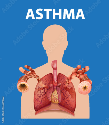 Comparing Normal and Asthma Lungs: A Medical Education Infographic