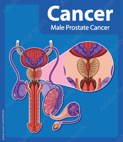 Comparing Normal and Cancerous Prostate in Male Anatomy