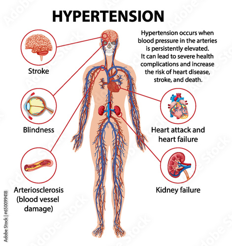Science Education on Hypertension's Effects on Human Anatomy