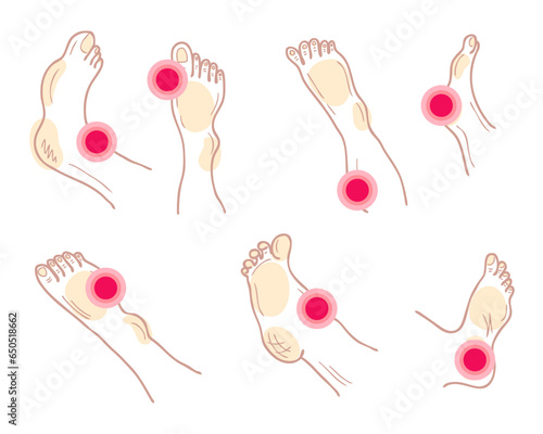 Painful feet and legs with ache mark collection. Muscle pain, medical and medicine concept. Isolated vector illustration.