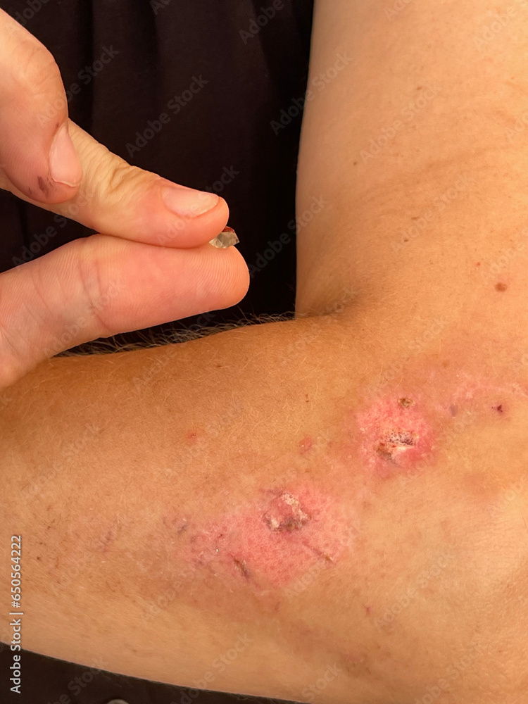 Fototapeta premium Female arm with injury scar after car accident