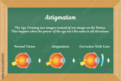 Astigmatism in eye disorders vector illustration