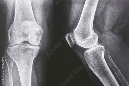 Knee xray. Knee xray. Front and lateral view. Healthcare. Examination