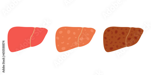 Liver organ stages damage. Healthy, fatty liver, fibrosis, cirrhosis. Liver disease. Vector photo