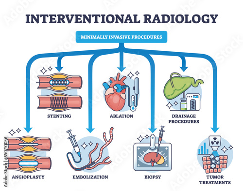 Interventional radiology as minimally invasive procedures outline diagram. Labeled educational scheme with medical biopsy treatment process for tumors, stenting and angioplasty vector illustration.