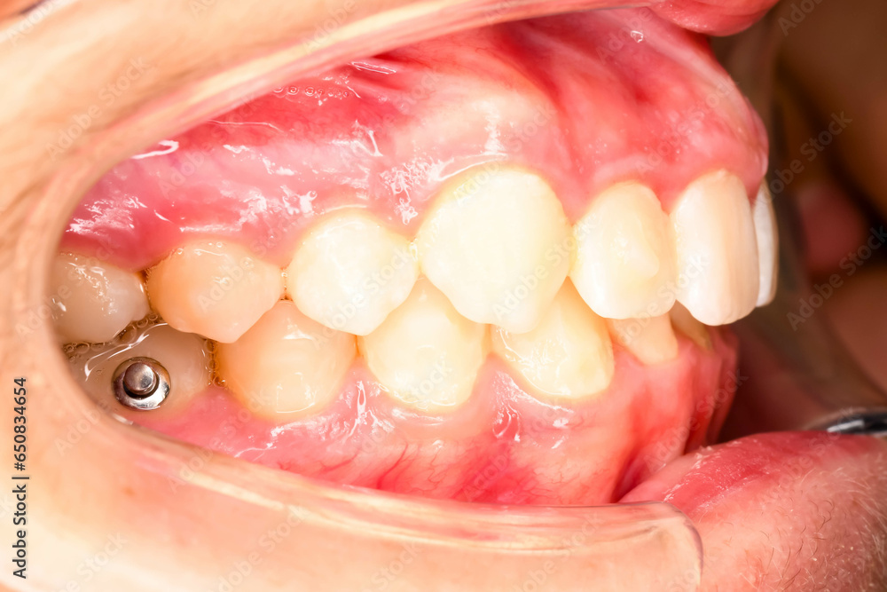 Obraz premium Orthodontist's work on a mouth close-up