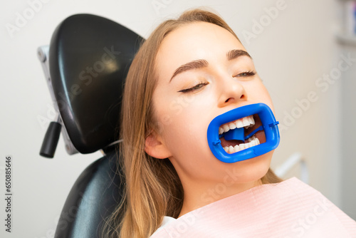 Fotografie A mouth prop or lip opener retractor in woman mouth for procedure of teeth whitening