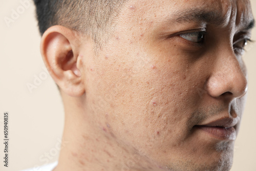 Photo of a young Asian man with an acne problem, close-up concept.
