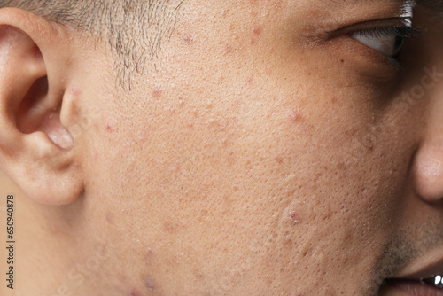 Photos Photo of a young Asian man with an acne problem, close-up concept