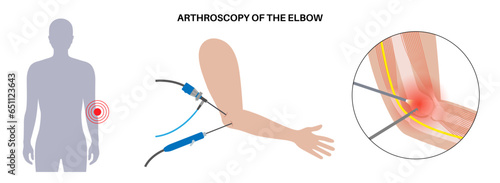 Elbow arthroscopy surgery