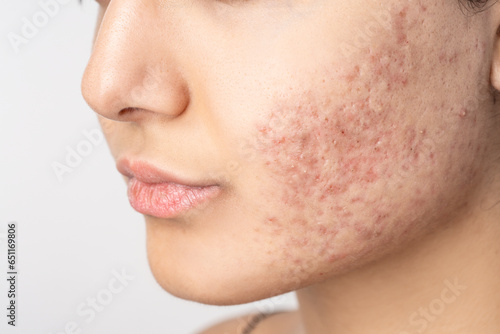 Картината върху платно Acne on the young girl's face. Acne in teenage girl