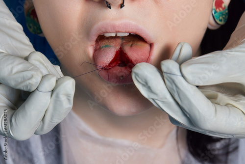 Fotografija tongue splitting