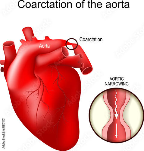 Aortic coarctations. Congenital heart defect. photo