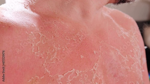The man skin sunburn on the seashore. Close up