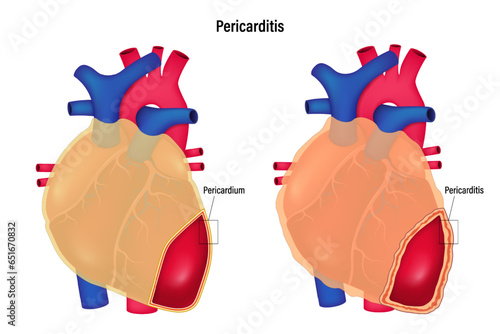 Pericarditis vector. Comparison between pericardium and pericarditis. Human heart anatomy. photo
