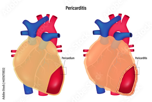 Pericarditis vector. Comparison between pericardium and pericarditis. Human heart anatomy.