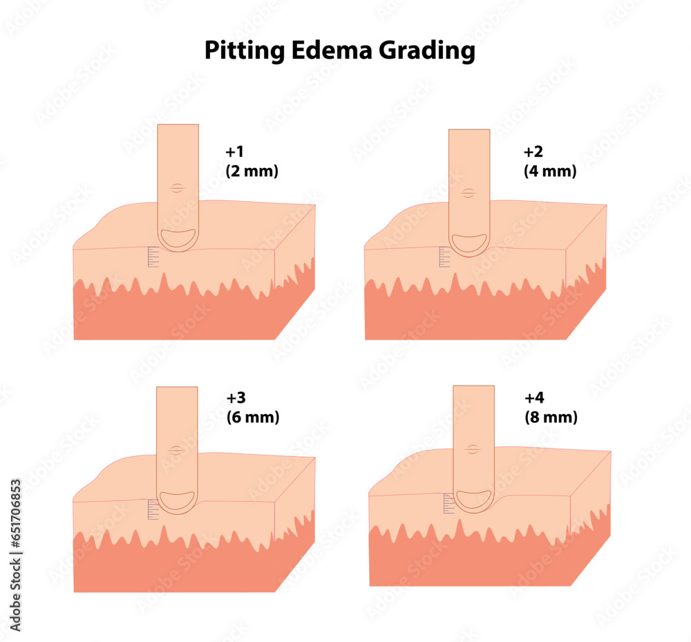 Pitting edema grading illustration with the grades and mm representation Stock ベクター Adobe Stock
