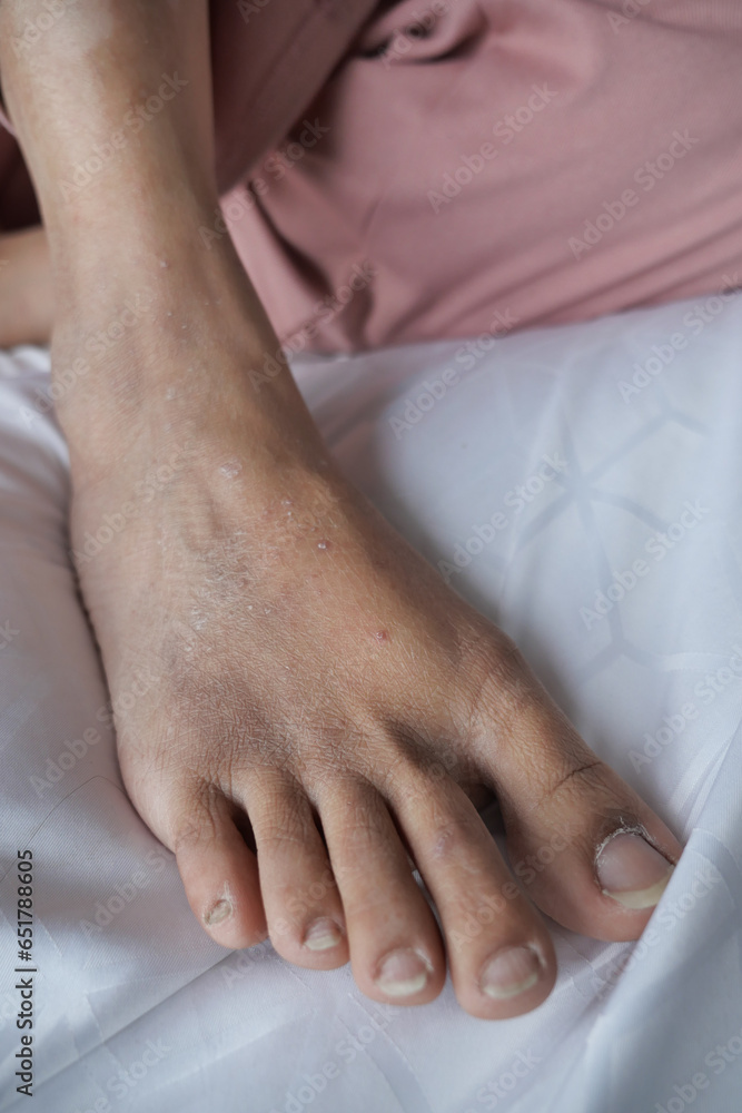 close up of women feet with swelling 