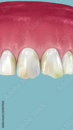 Dental veneers placement over teeth and happy smile at the end. 3D animation