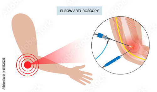 Elbow arthroscopy surgery