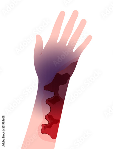 Hand skin infection of the Necrotizing fasciitis cause limb leg pain with scab fat cancer care
