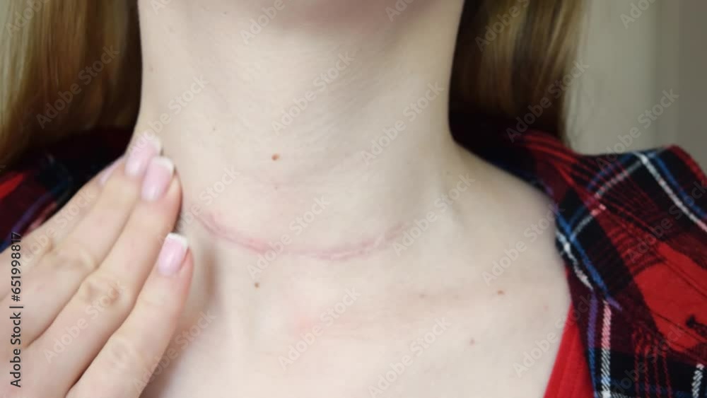 scar after surgery on woman neck scar after surgery on woman neck