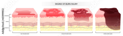 Stages of skin burn injury and scalds of epidermis and dermis layer cause by flames
