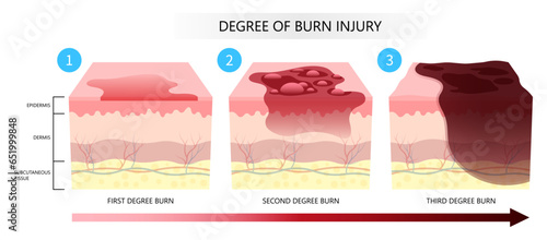 Skin burn injury degree of epidermis tissue layer with flames exposure photo