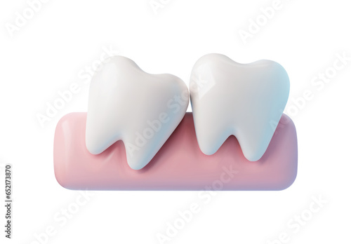 3D tooth grow incorrectly, tilted eruption problems, inflamed gums, vector realistic jaws dental anatomy illustration