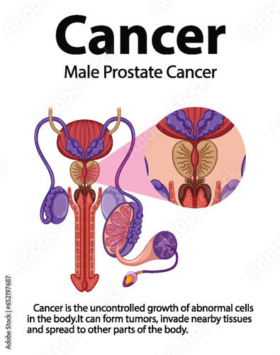 Male Prostate Cancer: Comparing Normal and Abnormal Cell Growth
