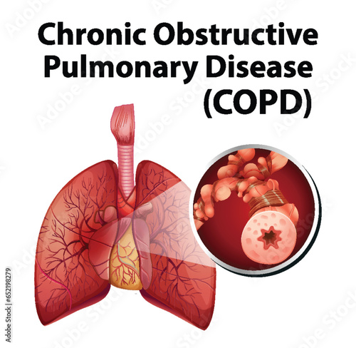 Science Education of Human Anatomy: COPD Infographic