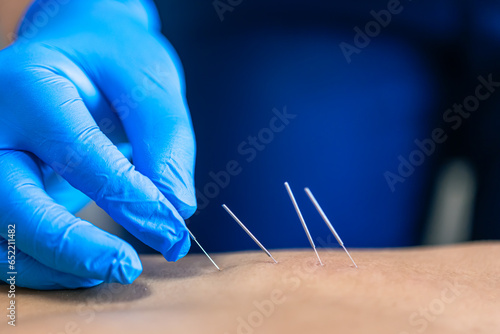 Close up of a needle and hands of physiotherapist doing a dry needling.