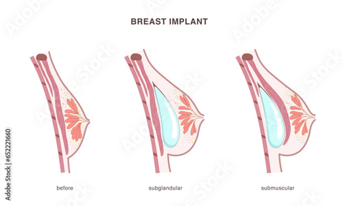 Silicone implant placement under the gland and muscle in female breast. Side view cross section of before and after operation. Flat style chart.