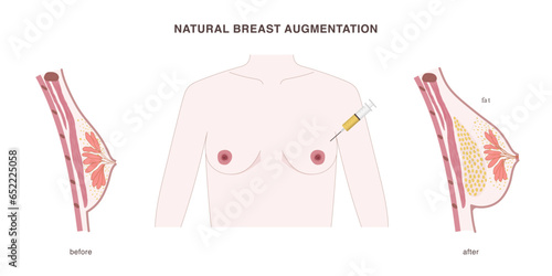 Natural breast augmentation with fat transferred into the breast from other body parts. Fat tissue injection illustration with before and after effect.