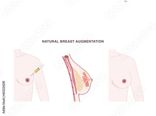 Natural breast augmentation with fat transferred into the breast from other body parts. Fat tissue injection illustration with before and after effect on nude body shape..