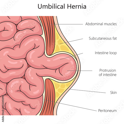Umbilical hernia structure scheme diagram schematic raster illustration. Medical science educational illustration photo