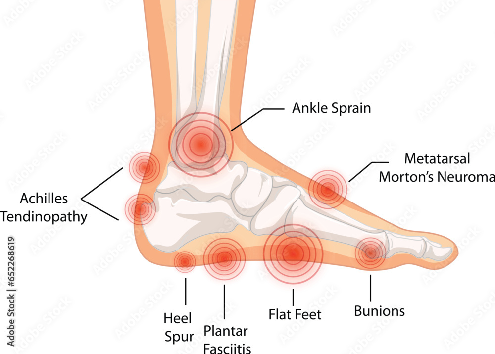 Collection of vector medical sprain infographic templates for ...