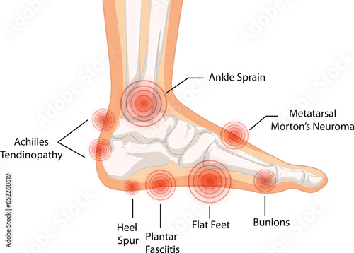 Collection of vector medical sprain infographic templates for presentations, advertising, layouts, annual reports. ankle sprain