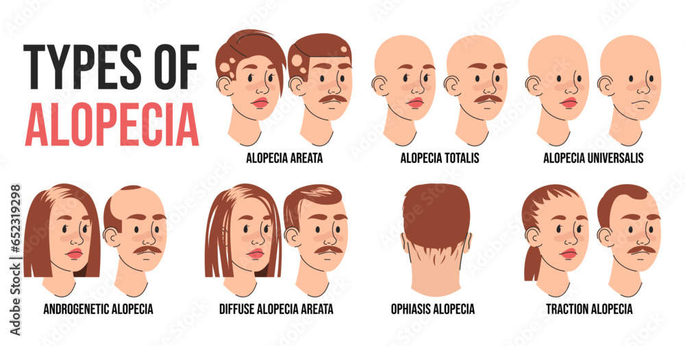Types of alopecia infographic vector isolated. Illustration of people suffering from hair loss. Alopecia areata, totalis and universalis. Androgenetic and traction alopecia. - obrazy, fototapety, plakaty 