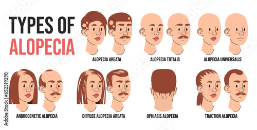 Types of alopecia infographic vector isolated. Illustration of people suffering from hair loss. Alopecia areata, totalis and universalis. Androgenetic and traction alopecia.