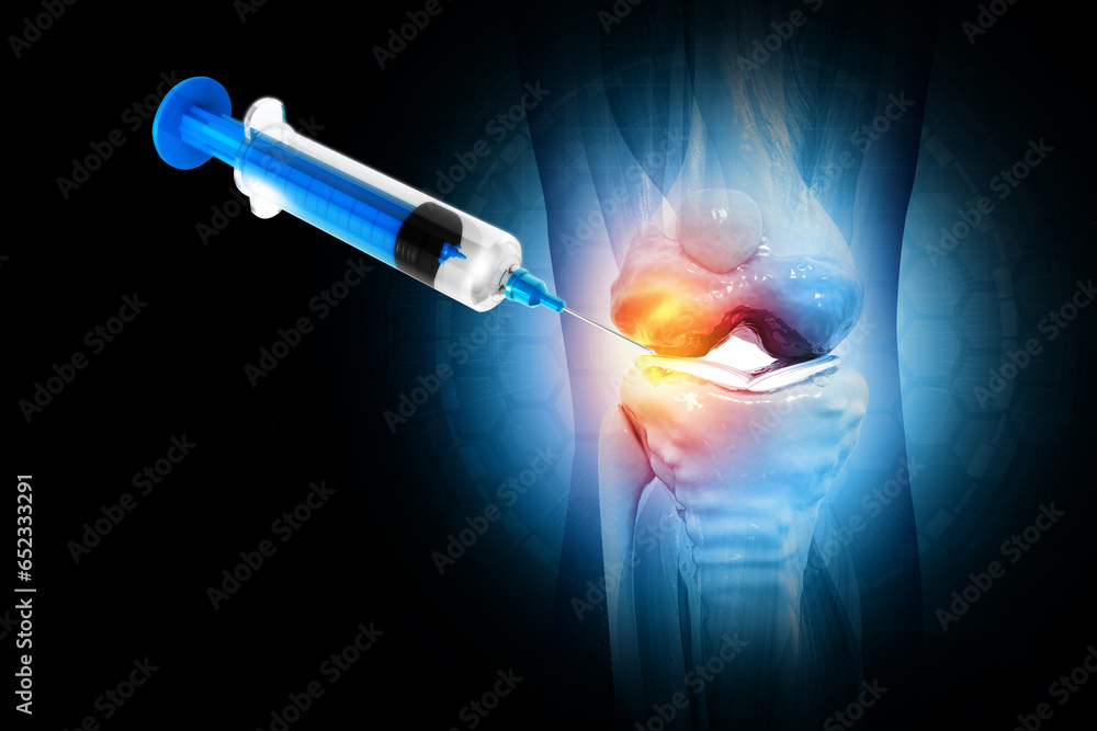 Anatomy Human Knee Joint Treatment, Osteoarthritis Injection, Drug