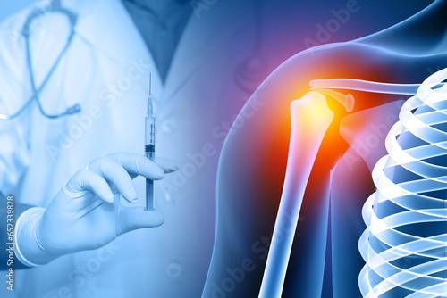Shoulder Joint Injection, shoulder joint pain, x-ray view, shoulder ligament tendinitis, shoulder muscle strain. 3d illustration photo