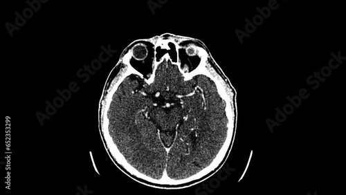 Magnetic resonance imaging of the brain. MRI of the brain. Medical examination of the human brain